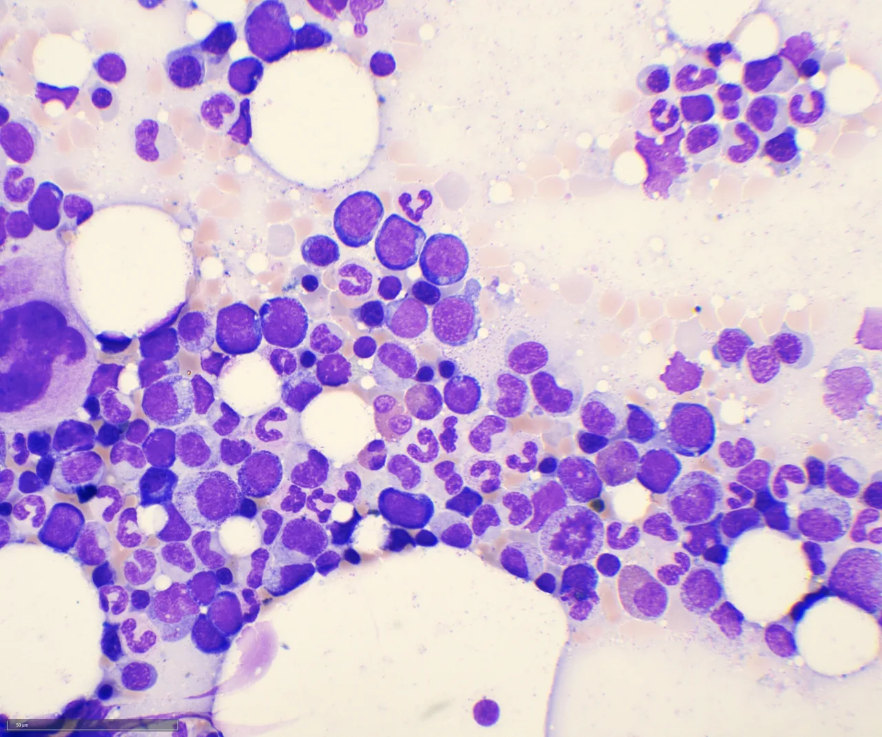Wright-Giemsa stained bone marrow aspirate smear showing acute lymphoblastic leukaemia (ALL) cells